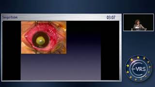 Last Chance for Treatment of Hypotony Anterior Encircling Scleral Band [upl. by Maureen]