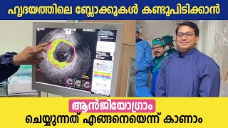 ഹൃദയത്തിലെ ബ്ലോക്കുകൾ കണ്ടുപിടിക്കാൻ ആൻജിയോഗ്രാം ചെയ്യുന്നത് കാണാം  Angiogram Malayalam video [upl. by Segalman]