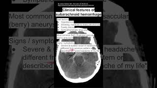 Clinical features of subarachnoid hemorrhage [upl. by Debbra478]