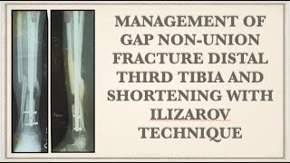 MANAGEMENT OF GAP NONUNION FRACTURE DISTAL TIBIA AND SHORTENING WITH ILIZAROV TECHNIQUE [upl. by Bartholomeus]