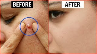 एक ही रात में Pimples हो जाएंगे गायब  Remove Pimples Overnight  Anaysa [upl. by Peti595]