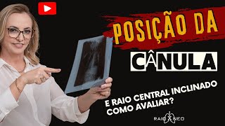 Como avaliar a posição da cânula traqueal com raio central inclinado [upl. by Hokanson]