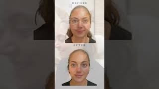 Masseter Botox [upl. by Ambrosius]