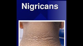 Acanthosis Nigricans [upl. by Cathleen30]