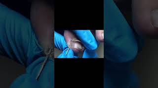 Quickly Trim Curved Ingrown Toenails To Ensure Healthy Toes【Mr Lin Toenail】 [upl. by Leahci]