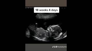 Baby Profile on 2D Ultrasound at 18 Weeks 4 Days Pregnant [upl. by Rosenblast]