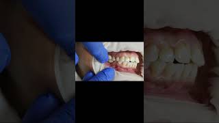 2 unit lower molar implant bridge PMMA for basal dental implants fitting video shorts [upl. by Clayson579]