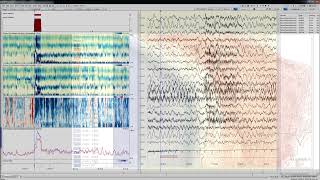 Seizure Review in Persyst [upl. by Aneleh]