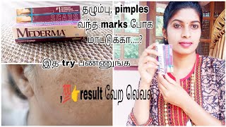 Mederma 👉💯 தழும்பு🤣pimples வந்த scars போகவே மாட்டுக்காஇத மட்டும் try பண்ணுங்க [upl. by Sutsuj]