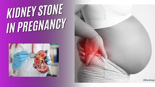 किडनी की पथरी और प्रेगनेंसी क्या है लक्षणख़तरें एवं इलाज। KIDNEY STONE IN PREGNANCY [upl. by Axia]