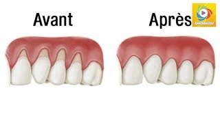 Arrêtez la rétraction de vos gencives et soignezla avec ces remèdes naturels  Random888 [upl. by Eimmac]