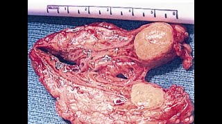 ENDOCRINOLOGY WK3MonSPR20 Hyperaldosteronism [upl. by Vachel]