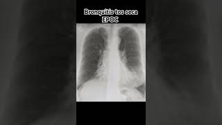 BRONQUITIS TOS SECA EPOC [upl. by Egan]