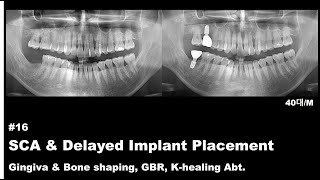 16 SCA amp Delayed Implant Placement Gingiva amp Bone shaping GBR [upl. by Dianthe]