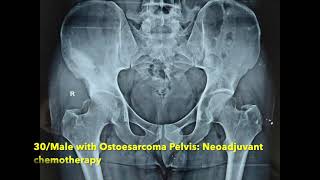 Hemipelvectomy Surgery for Pelvic Bone tumors  Walking video after surgery [upl. by Madlin]