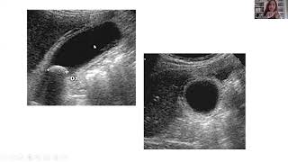 Echographie de la vésicule biliaire [upl. by Shaer271]
