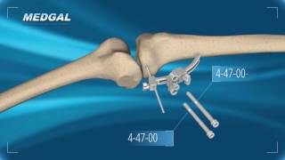 Tibial Osteotomy TECHNIQUE [upl. by Eiramanel]