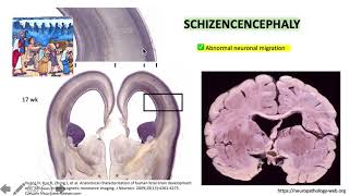 Porencephaly versus Schizencephaly 22 [upl. by Marsland]