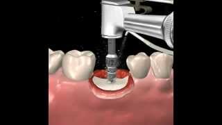 Step by step dental implant surgery Gary R OBrien DDS [upl. by Deedahs]