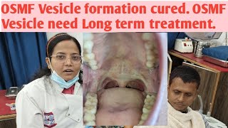 OSMF Vesicle formation cured OSMF Vesicle need Long term treatment amp follow Patient result after Tt [upl. by Acsecnarf]