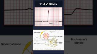 First Degree Atrioventricular Block ECG [upl. by Jehanna16]