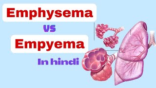 empyema vs emphysema  Difference between emphysema and empyema  nursing class in hindi  empyema [upl. by Ahseral]