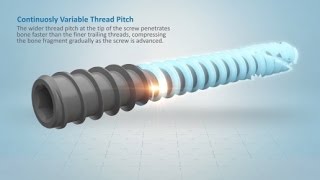 Acutrak 2 Headless Compression Screw System Overview [upl. by Adnolohs]