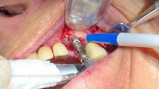 FULL OSSEOINTEGRATED IMPLANT REMOVAL [upl. by Lita]