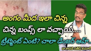 Molluscum Contagiosum Treatment In Telugu  Doctor Satheesh  Yes1TV Health [upl. by Portland]