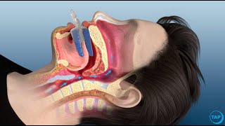 flexTAP Oral Appliance for Sleep Apnea How Does It Work [upl. by Cadell]