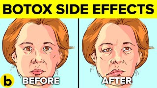 5 Side Effects Of Botox Injections You Should Be Aware Of [upl. by Nyrhtakyram100]