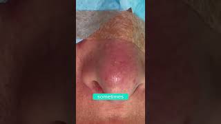 HANGING COLUMELLAR REDUCTION  DR TANVEER JANJUA NEW JERSEY [upl. by Sesiom]