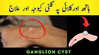 Ganglion cyst causes symptoms and treatment  Wrist ganglion cyst explained [upl. by Sterner845]