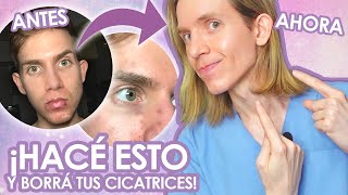 COMO BORRÉ MIS CICATRICES DE ACNE  Recomendaciones de un dermatólogo  Simon Scarano [upl. by Little]