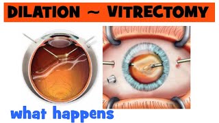 How long does eye dilation last My vitrectomy after a year [upl. by Assenna]