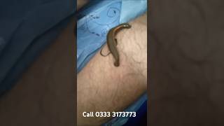 veins treatment leech therapy  jonk therapy for vericose [upl. by Ynottirb432]