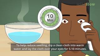 How to Get Rid Of a Stye [upl. by Eenet]