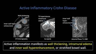 Crohn Disease Part 1 Active Inflammation [upl. by Eceinert]