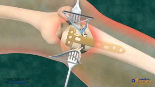 High Tibial Osteotomy HTO for Bow Leg Correction [upl. by Ennaeerb416]