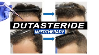 Mesotherapy with Dutasteride Injections Pros and Cons and what Results to expect [upl. by Aronson704]