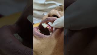 post ampcore gingivectomycrown cutting maxillary tooth [upl. by Adelric712]