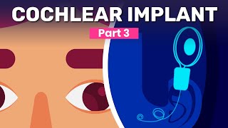 Cochlear Implant Surgery [upl. by Sprage217]