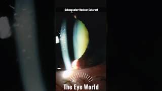 Subcapsular Nuclear Cataract [upl. by Rihat]