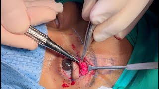 Frontalis Flap for Ptosis Repair [upl. by Thistle]