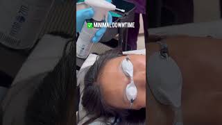 Effortlessly remove brown spots with Cryotherapy—quick minimal pain and effective results [upl. by Marcello344]