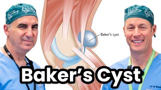 Understanding and Treating Bakers Cyst [upl. by Pliam]