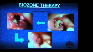 OxygenOzone Treatments in Dentistry Part 2 [upl. by Annel]