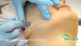 Microdermabrasion step by step demonstration [upl. by Htebsil]