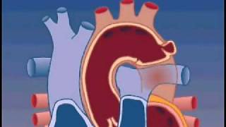 Causes of Aortic Aneurysms [upl. by Avehsile]