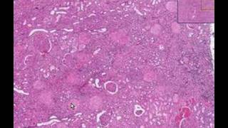 Histopathology KidneyDiabetic glomerulosclerosis [upl. by Sonitnatsnoc296]